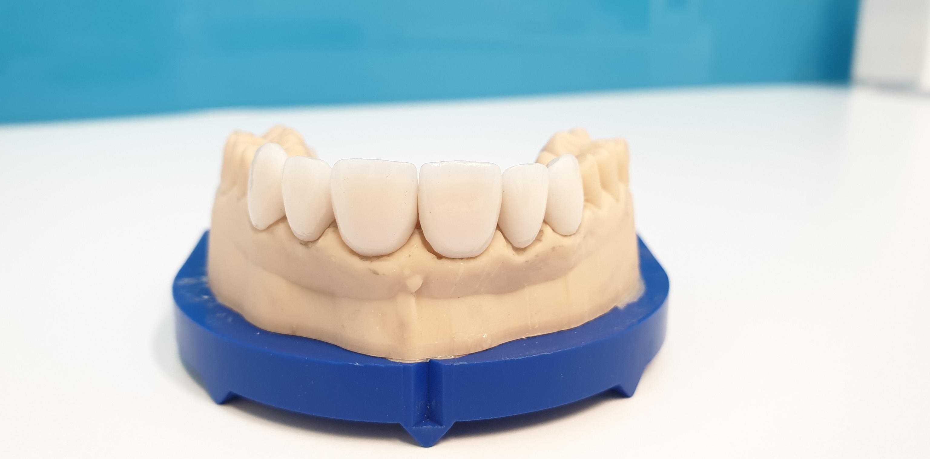 How Much Do Veneers Cost in Sydney? A 2026 Guide to Composite vs Porcelain
