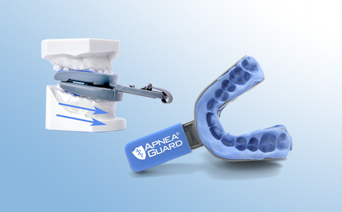 Temporary Snoring/Obstructive Sleep Apnoea Appliance