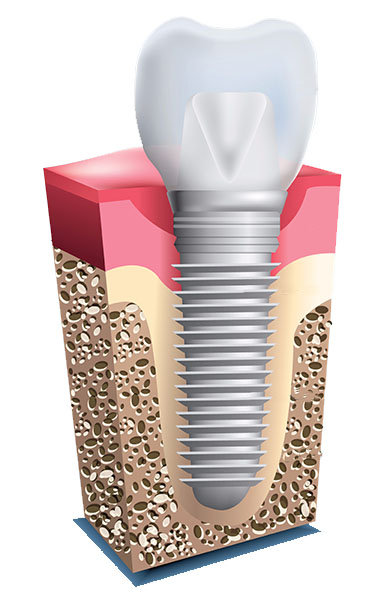 Dental Implants