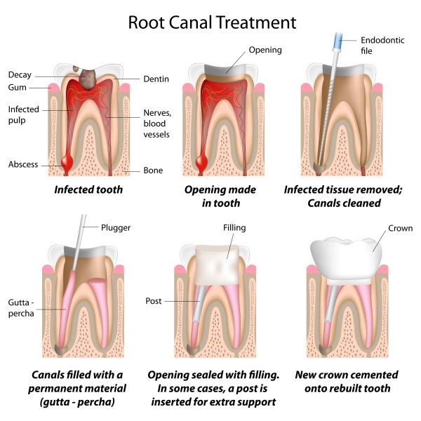 Root canal therapy is the treatment of teeth that have had nerve damage, whether it be by decay or trauma. Root canal therapy preserves the natural tooth and thus the natural bone level. It is always advisable, if possible, to save natural teeth as extracting them can cause issues with aesthetics and function.
Root canal therapy is typically done over a few visits depending on the number of nerves and severity of infection. Initially, the tooth is anaesthetised and an opening made though the crown, exposing the infected/damaged nerve. The root canal system is then cleaned out, enlarged and antimicrobial agents placed. X-rays will be taken throughout the procedure to ensure that the whole length of the root canal is cleaned. Finally, a natural rubber compound is placed in the root canal system to prevent reinfection.
