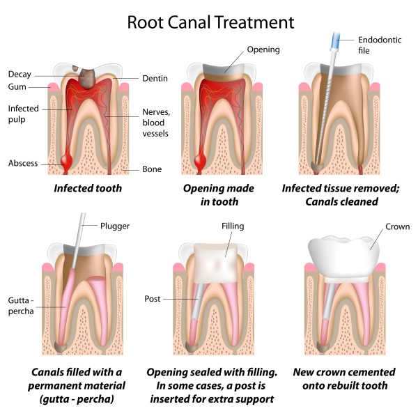 Root canal therapy is the treatment of teeth that have had nerve damage, whether it be by decay or trauma. Root canal therapy preserves the natural tooth and thus the natural bone level. It is always advisable, if possible, to save natural teeth as extracting them can cause issues with aesthetics and function.
Root canal therapy is typically done over a few visits depending on the number of nerves and severity of infection. Initially, the tooth is anaesthetised and an opening made though the crown, exposing the infected/damaged nerve. The root canal system is then cleaned out, enlarged and antimicrobial agents placed. X-rays will be taken throughout the procedure to ensure that the whole length of the root canal is cleaned. Finally, a natural rubber compound is placed in the root canal system to prevent reinfection.