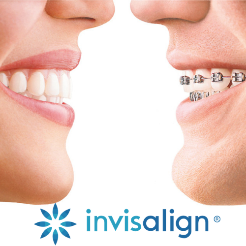 Invisalign - Invisible Braces