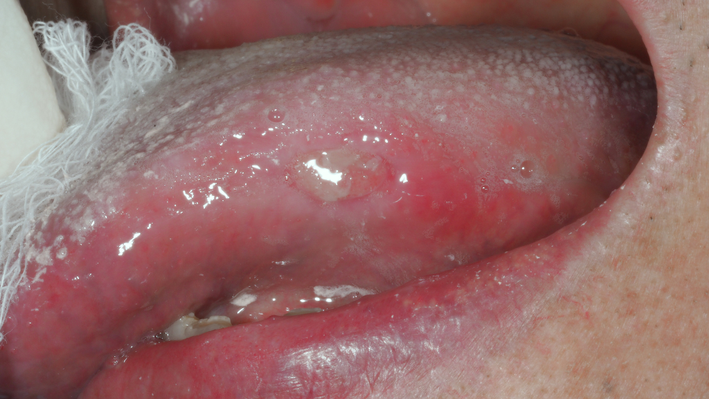Oral Cancer Screening