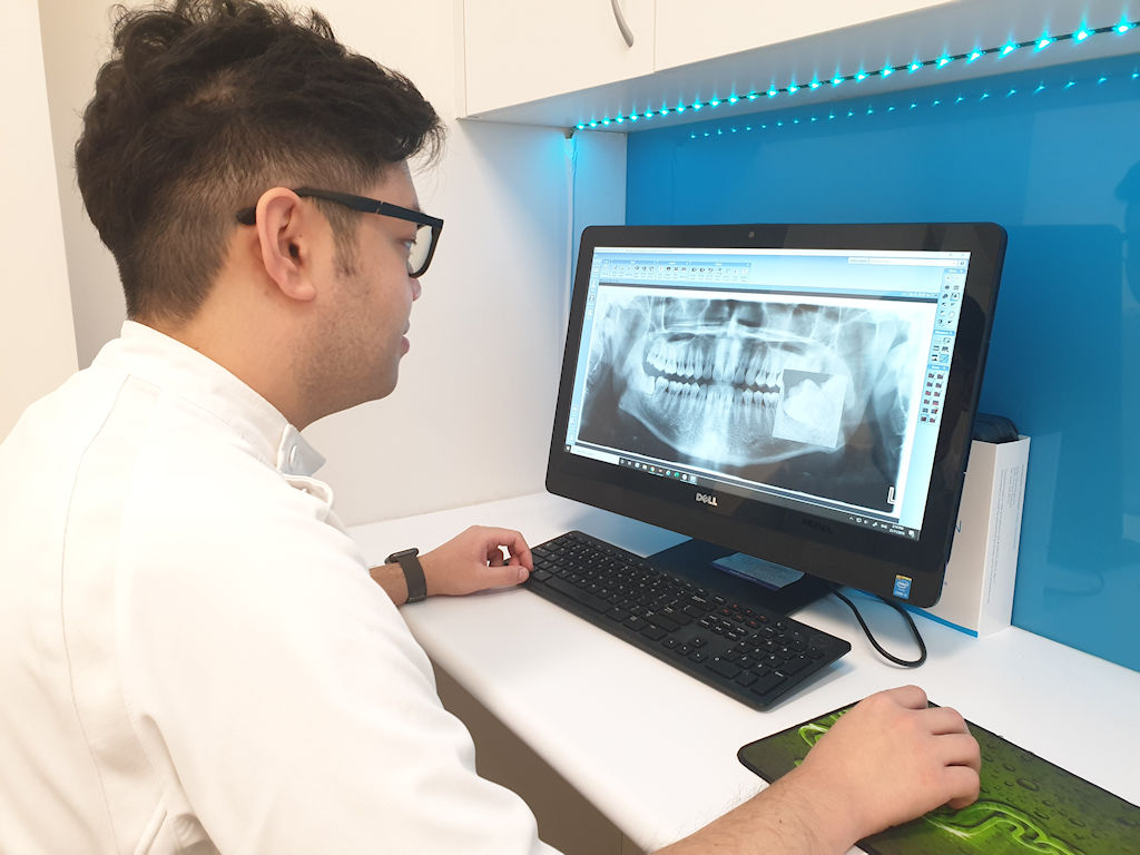 Wisdom teeth are the last teeth to erupt and due to this delay, they can cause different issues. If there is enough room in the jaw for them to come through, then they can be left alone. However if there isn’t enough room for them, they can become decayed, infected, develop cysts or cause problems with the teeth in front of them. In this case, it may be best to remove them.
Our dentists can take an OPG x-ray to assess the wisdom teeth. Sometimes these teeth can have very hooked roots or be in close proximity to nerves and so it is important to have a thorough assessment. We can then determine if it is necessary to remove them.
As with all types of surgery, dental extractions have associated risks and possible postoperative complications. Our dentists will discuss this with you before the surgery, and talk through ways to minimize complications.